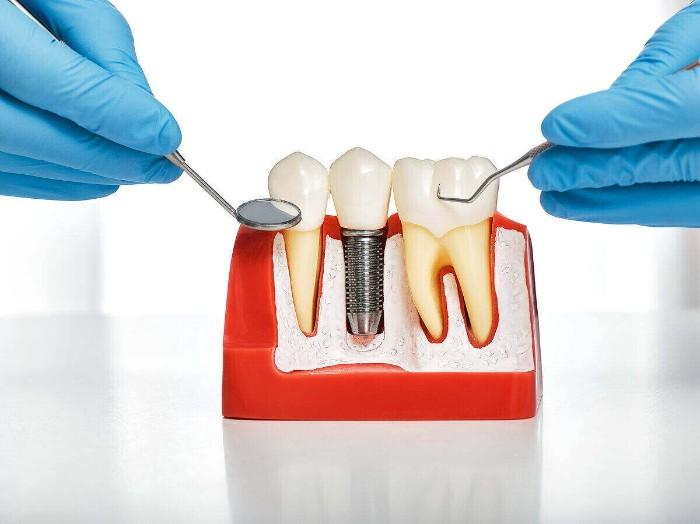 types-of-payment-plans-for-dental-implants-archives-balmoral-dental-centre