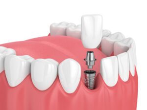 Dental Implants Bangkok procedure