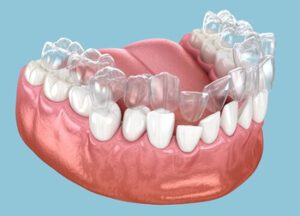 what does invisalign do crooked teeth