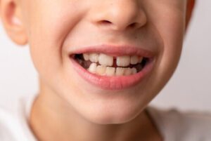 Can Invisalign Fix Crowding kids