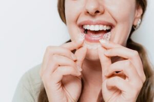 Can Invisalign Fix Crowding wear