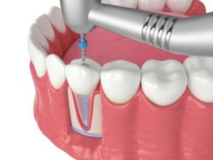 How Long Does a Root Canal Take procedure