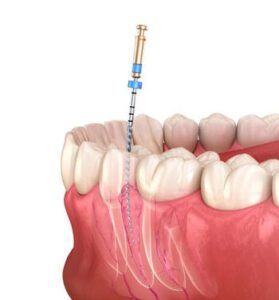 How Long Does a Root Canal Take steps