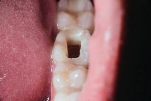 Impacted Wisdom Tooth removal