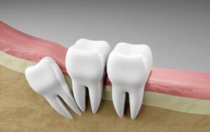 Impacted Wisdom Tooth retention