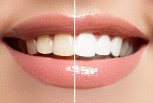 Zoom Teeth Whitening change